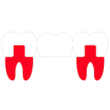 bridge dentaire