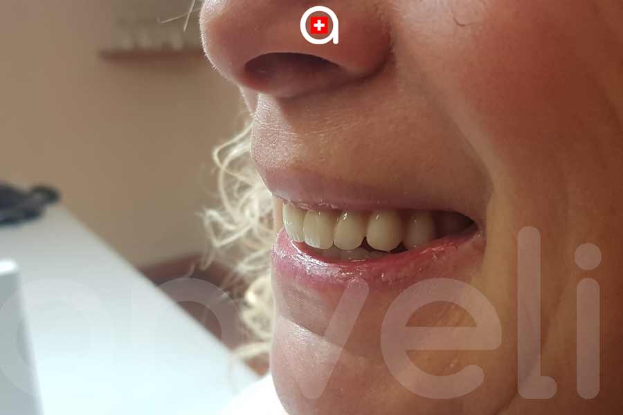 Implant dentaire basal pour la bouche complète