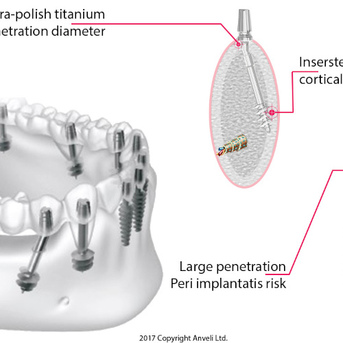 procédure implant bcs