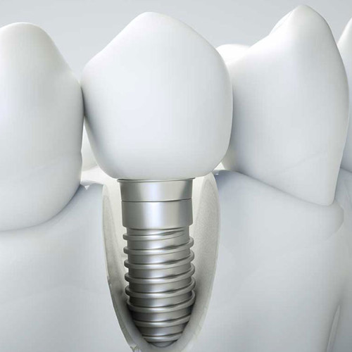 Causes du rejet infection d'un implant dentaire