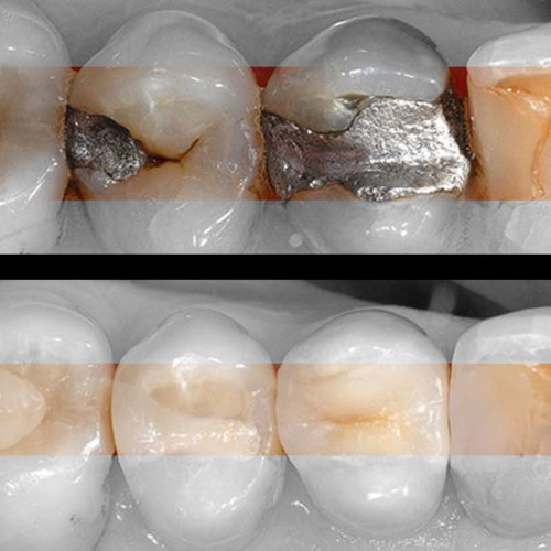 Anveli Dental - Décontamination aux métaux lourd