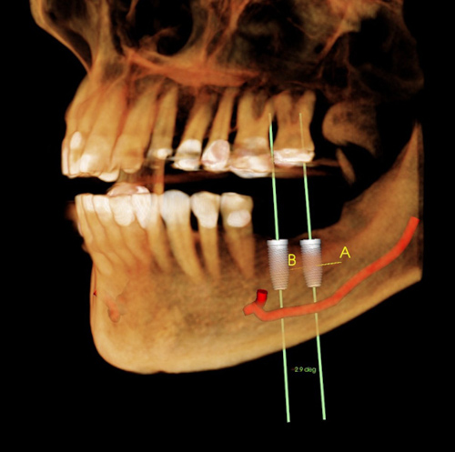 risque de section et d'endommagement du nerf pendant la pose d'un implant dentaire