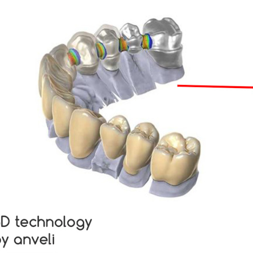 fabrication prothèse dentaire