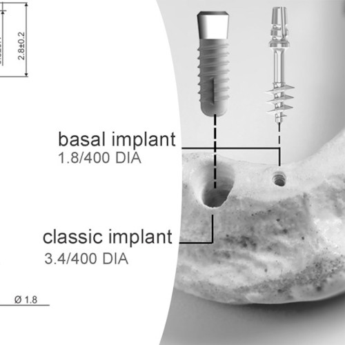 perforation et forage de l'os pour la pose d'un implant dentaire basal