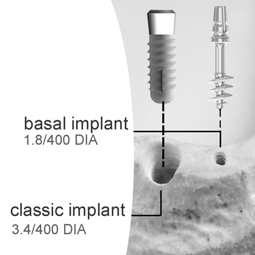 implant basal de dernière génération lequel choisir