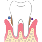 treatments for periodontitis