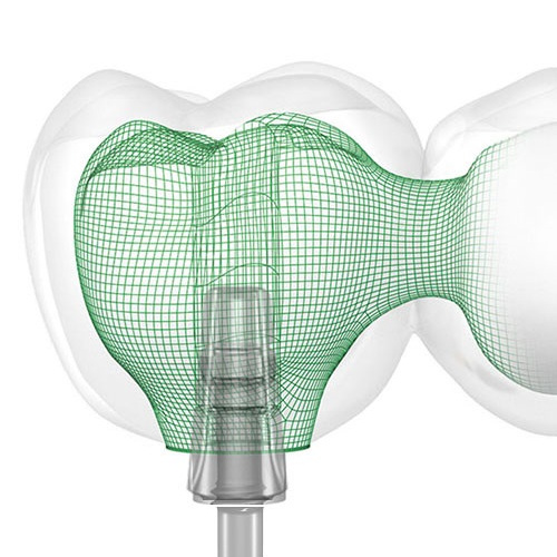 pose d'une prothèse dentaire fixe sur implant basal