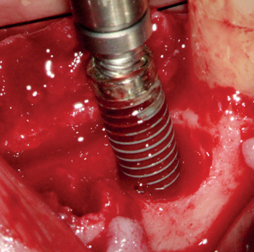 soigner une péri implantite ou infection de l'implant dentaire
