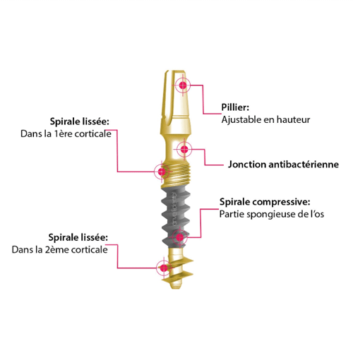 Les implants dentaires anveli dentaire basale de l'implant