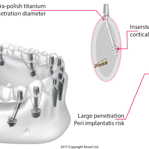 Operation basale Implantate anveli dental