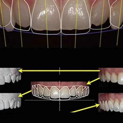 Dental Crowns by Anveli Dental