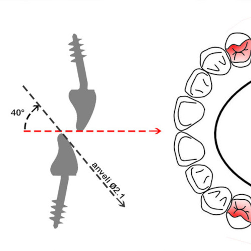 fixed prosthesis anveli dental