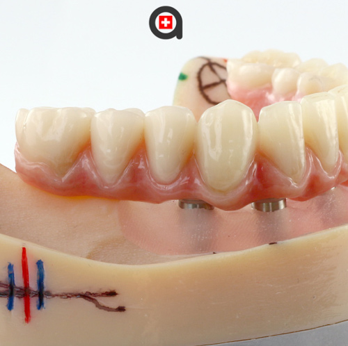 prótesis fija anveli dental