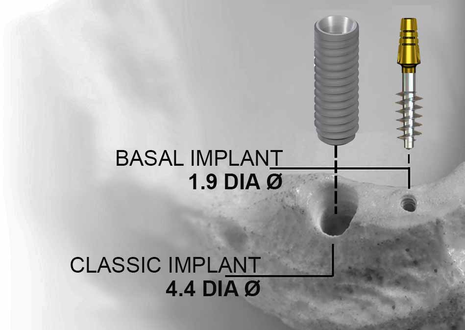 comparison of classic dental implant and basal implants. What is the best implant