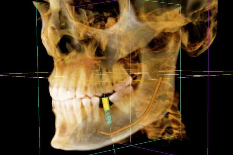 Placment of a dental implant procedure