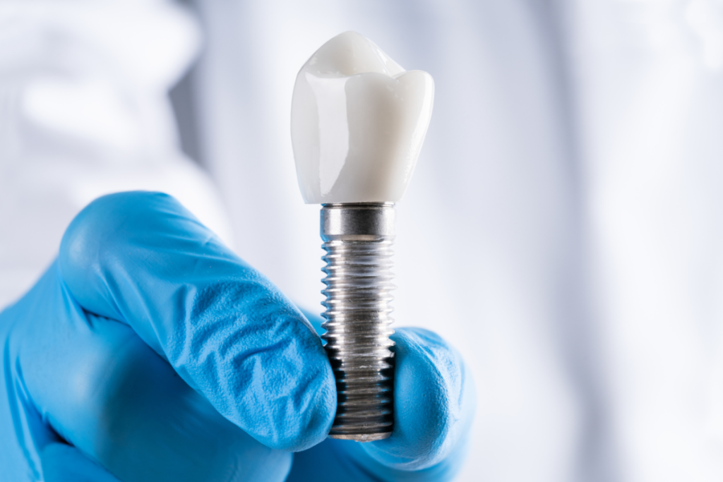 Un dentista sujetando un implante dental. 